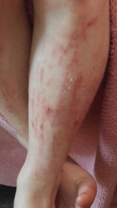 eczema